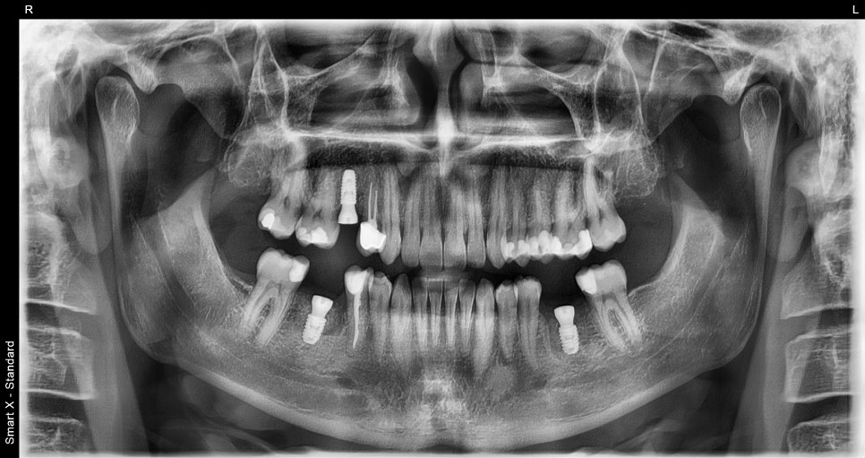 Implant Treatment Available for Foreign Residents Abroad! A Case Completed Perfectly Within 3 Months image 4