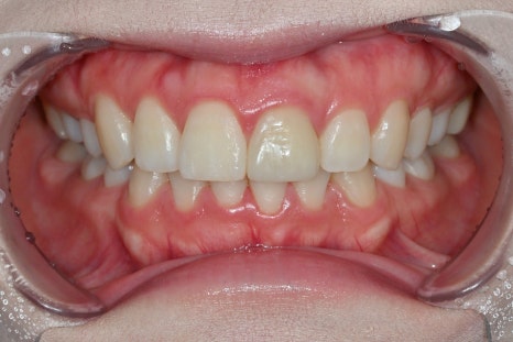 Rabbit Teeth Veneers: Treatment to Achieve Natural Front-Tooth Proportions image 2