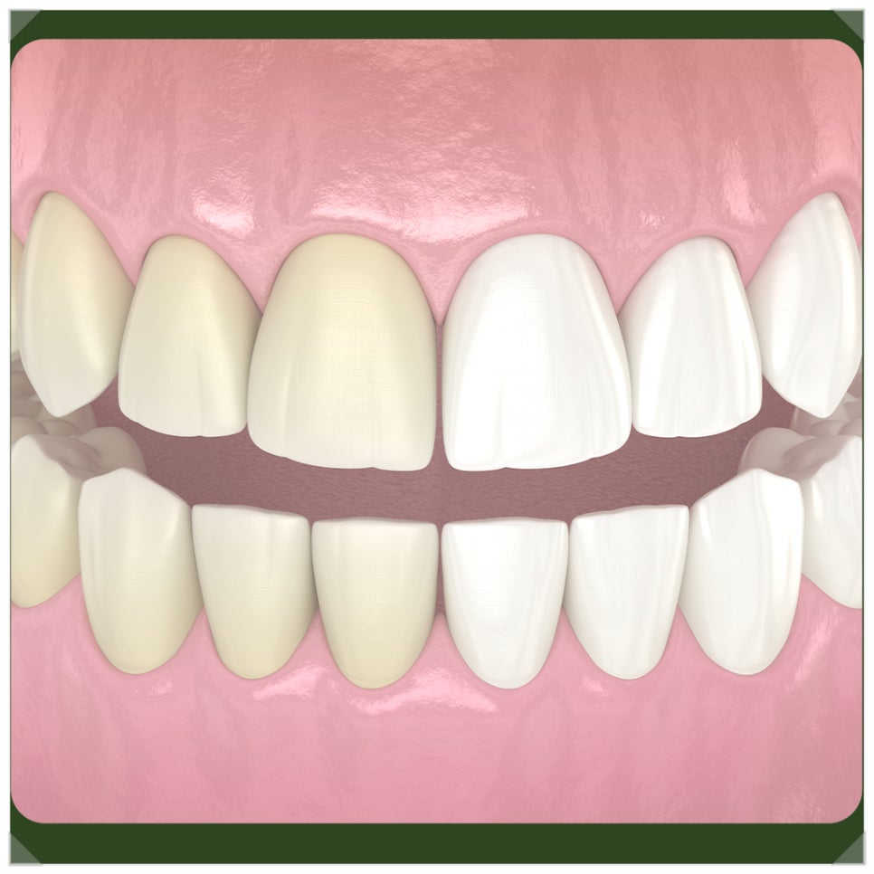 Precautions After Teeth Whitening: Please Be Careful About These Things! image 4