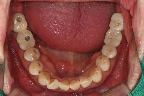 어금니 임플란트가격, 임플란트치과에서 진행한 실제 치료 과정 관련 이미지 9