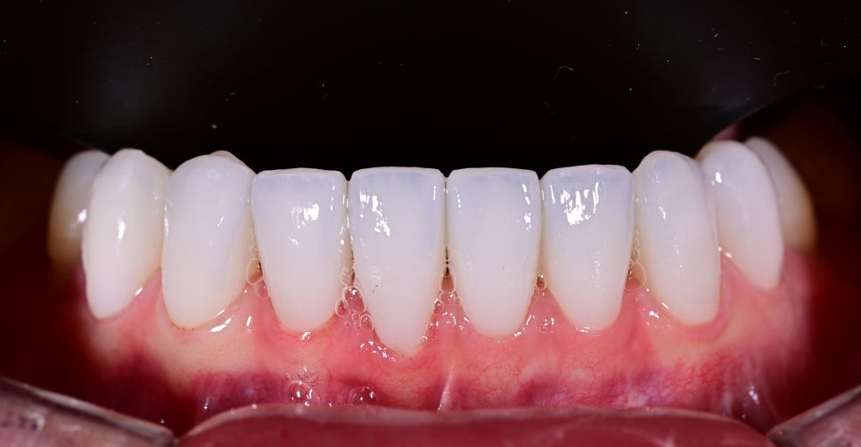 A Case of Simultaneous Laminate and Implant Prosthetic Treatment image 8