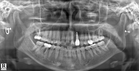 Possible Front Tooth Prosthetic Replacement Even While Staying Abroad! A Natural Smile Completed on a Short Schedule✨ image 1
