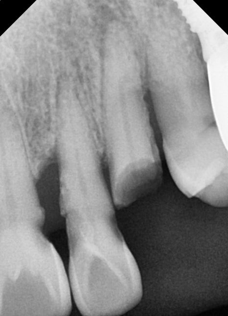 앞니 임플란트, 전치부 심미까지 살린 치료 과정 정리 관련 이미지 10