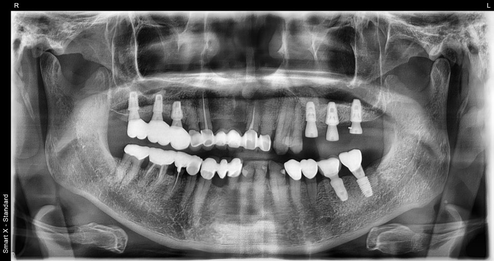 Broken Implant Crown, Reproduced at Seoul Of Dental Clinic Even for Implants from Another Clinic🦷 image 3