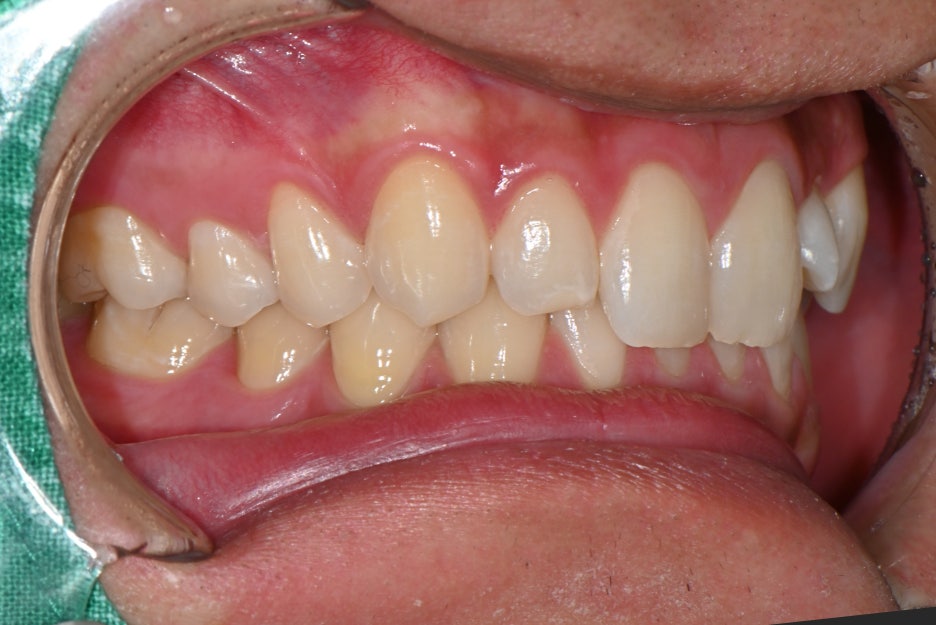 Object Zero Front Tooth Laminate, Minimizing Tooth Reduction image 10