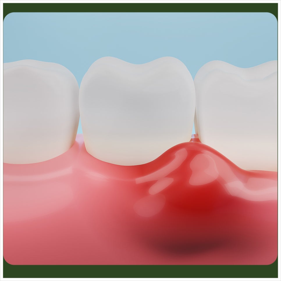 Pregnancy gingivitis may be difficult, but it needs to be managed! image 2