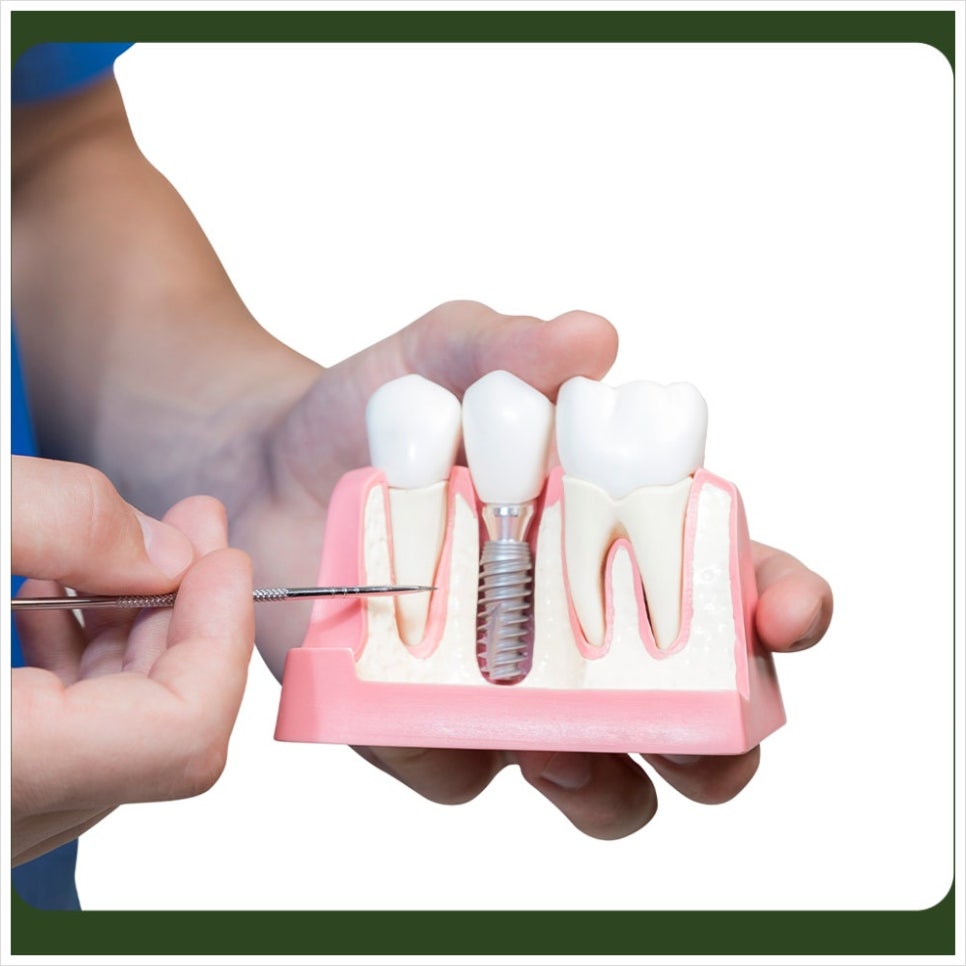 Implant Bleeding Control: When Does the Bleeding Stop? image 5