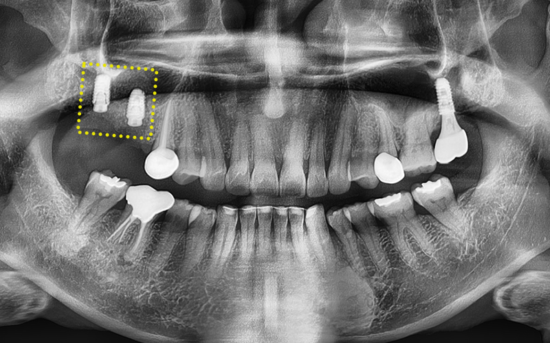 Songpa-gu Dental Clinic: Solving a Case Where Prosthetics Were Impossible with Implant Reoperation! image 7