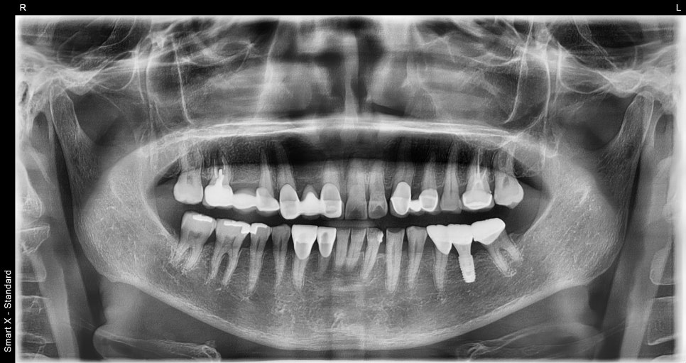 Front Tooth Crown + Implant for an Overseas Patient: What Made It Possible to Finish in 4 Months? image 7