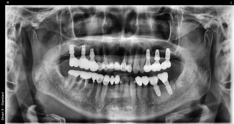 Broken Implant Crown, Reproduced at Seoul Of Dental Clinic Even for Implants from Another Clinic🦷 image 4