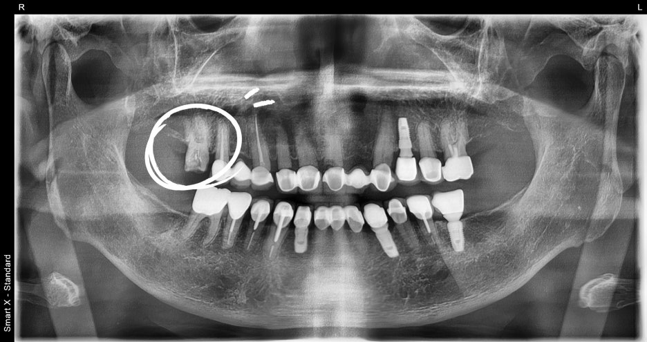 Why the First Root Canal Procedure Must Be Handled by a Specialist image 3