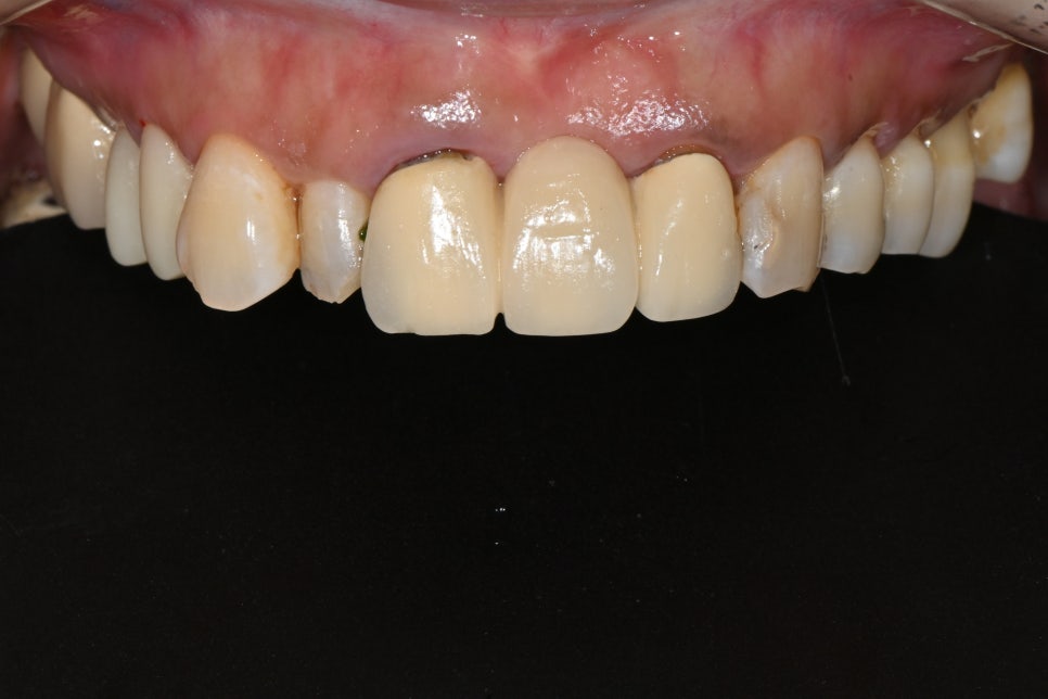 오브제로라미네이트, 무삭제라미네이트 자연스럽게 가능할까?(OVZERO Veneers, Is No-Prep Veneer Really Possible?) 관련 이미지 14