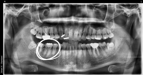 Inlay Treatment Review in Songpa-gu, Seoul – Completed in 1 Week with Precision Scanning and Lab Work image 2