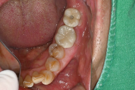 No Problem Even for Implants from Another Clinic! If You Only Need Screw Hole Filling, Seoul Of Dental Hospital Can Help🛠️ image 3