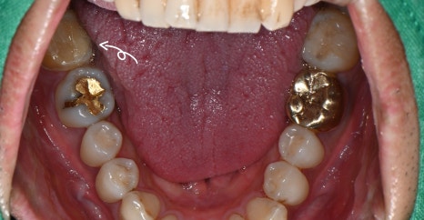 Inlay Treatment Review in Songpa-gu, Seoul – Completed in 1 Week with Precision Scanning and Lab Work image 3