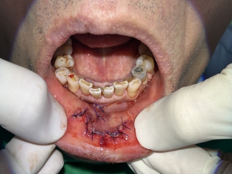 A Broken Front Tooth from a Fall, Restored Along with the Gums! Emergency Treatment Report from Seoul Ob Dental Hospital image 1