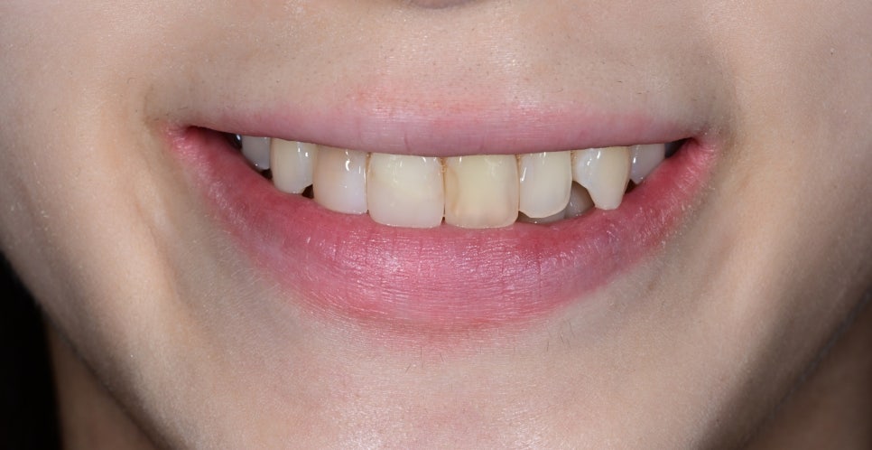 Discolored Front Teeth: Are Crowns the Only Answer? image 1