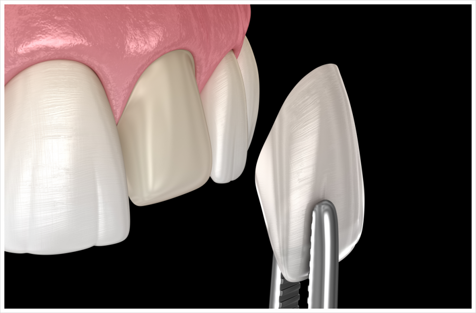 Concerned About Gaps Between Your Front Teeth? image 3