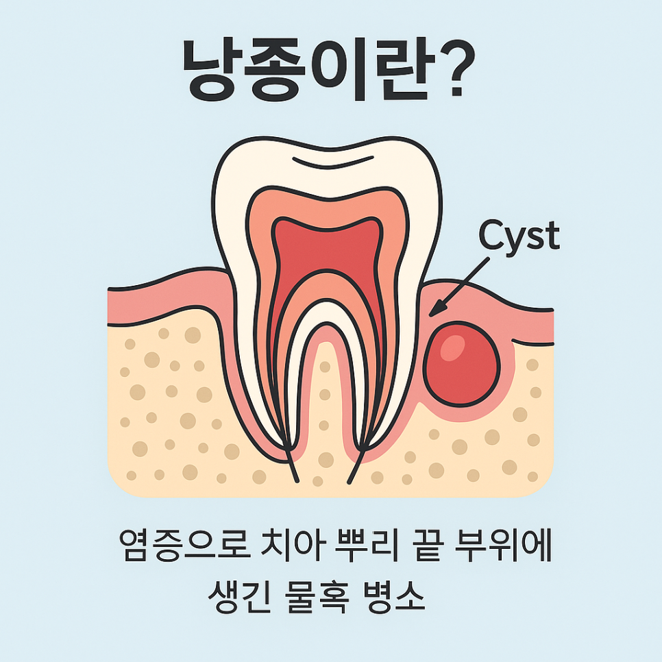 Cysts, If Left Untreated, Can Even Dissolve Bone. Introduction to an Accurate Diagnosis and Surgical Case image 1
