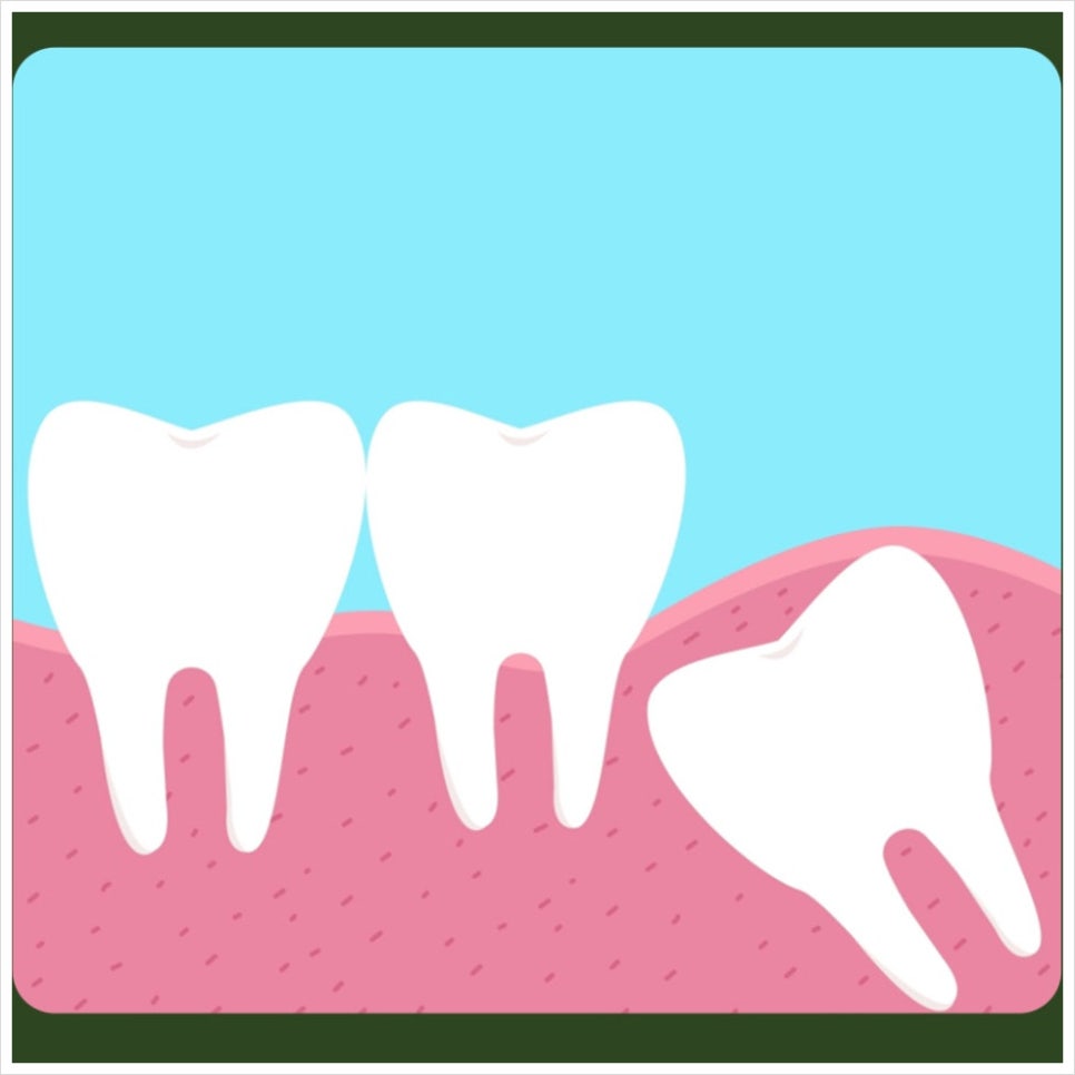 After Wisdom Tooth Extraction: What Should You Watch for With Bleeding Control? image 2