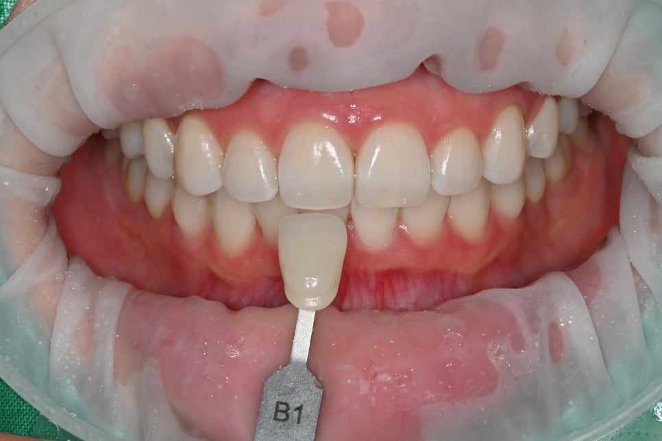 Songpa Teeth Whitening Price, Treatment Review image 18