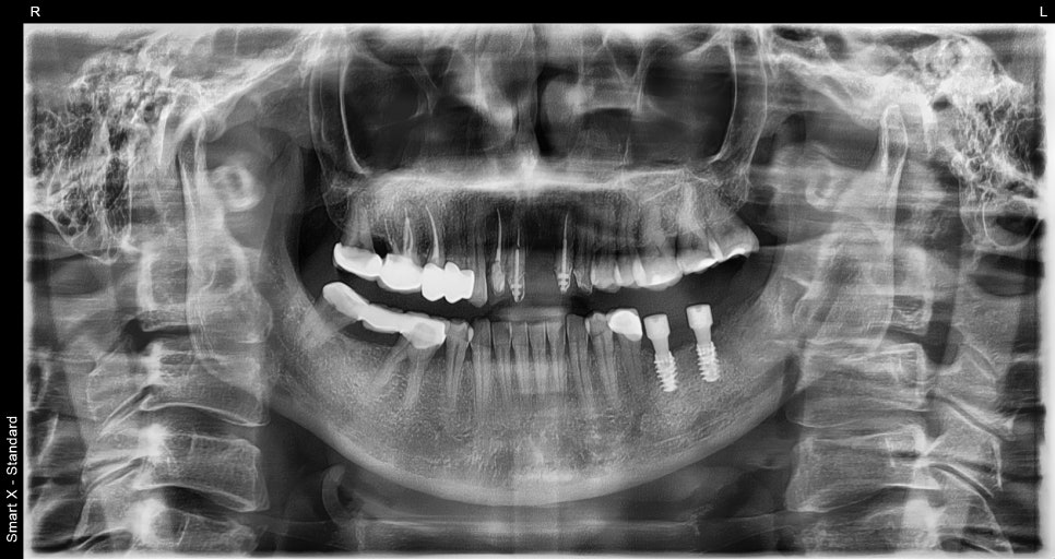 오브제로라미네이트, 무삭제라미네이트 자연스럽게 가능할까?(OVZERO Veneers, Is No-Prep Veneer Really Possible?) 관련 이미지 5