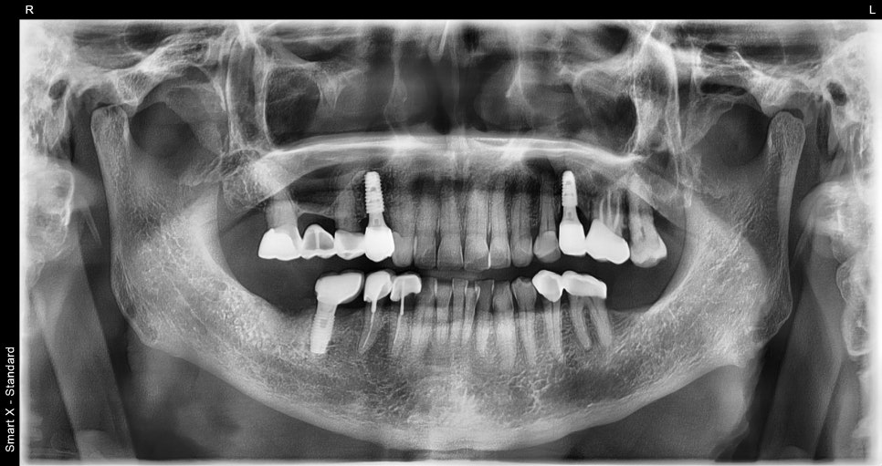 A Surgical Case of a Male Patient in His 70s Restoring Healthy Eating Habits with Insurance-Covered Implants image 3