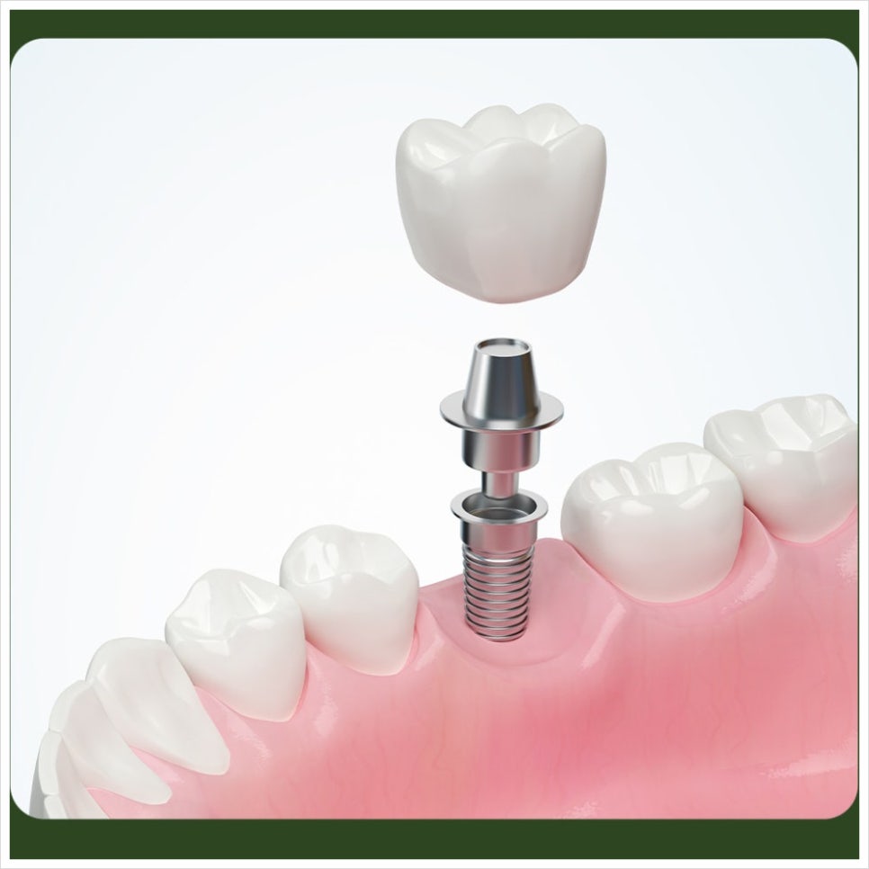 When Is Same-Day Implant Treatment Possible? image 5