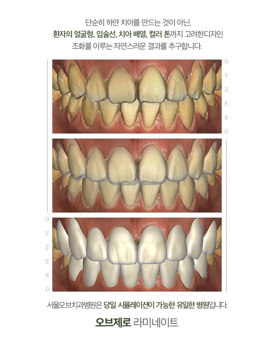 Natural-looking Front Teeth Completed with Laminate Veneers in Jamsil image 7