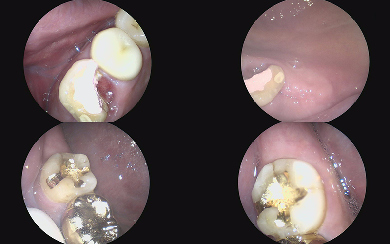 Songpa-gu Dental Clinic: Solving a Case Where Prosthetics Were Impossible with Implant Reoperation! image 4