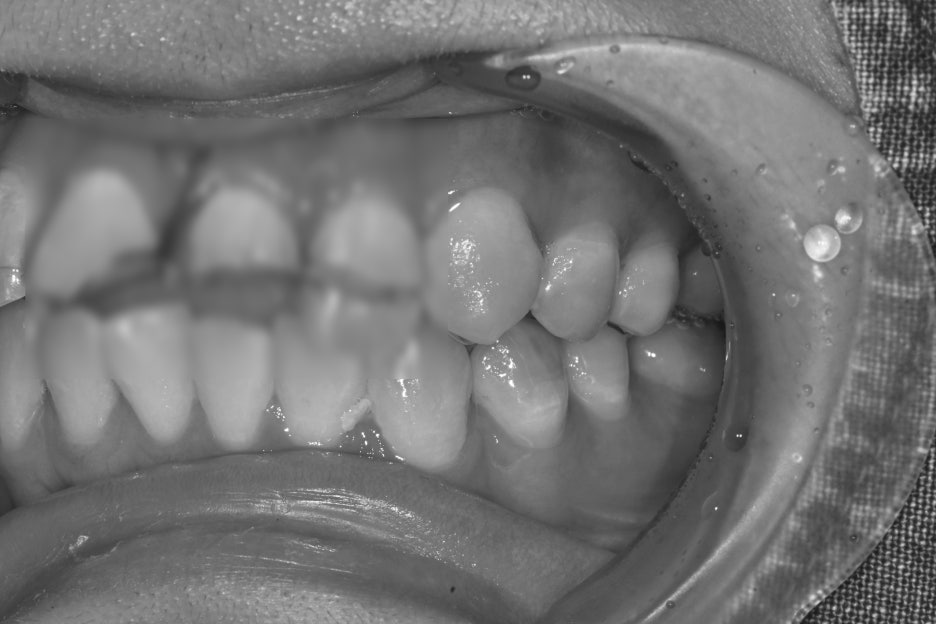 Songpa Dental Clinic, a Case of Crown Restoration After Root Canal Treatment for a Woman in Her 20s With a Broken Front Tooth image 5