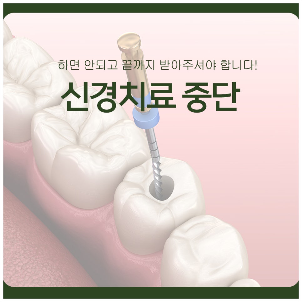 Stopping Root Canal Treatment Is Not Okay — You Must Finish It to the End! image 1