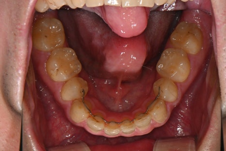 What If Your Orthodontic Clinic Has Closed? What to Do When a Retainer Falls Off image 2