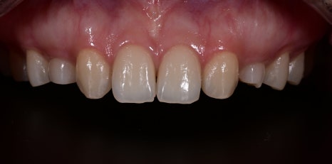 Minimally Invasive Laminate Veneers, Simultaneous Tooth Shaping with Obezero Laminate image 5