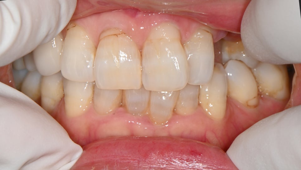 Songpa-gu Front Tooth Implant: Is It Possible Even in an Inflamed Area? image 1