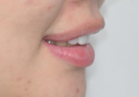 Jamsil Veneers: Worried About Rabbit Teeth? image 14
