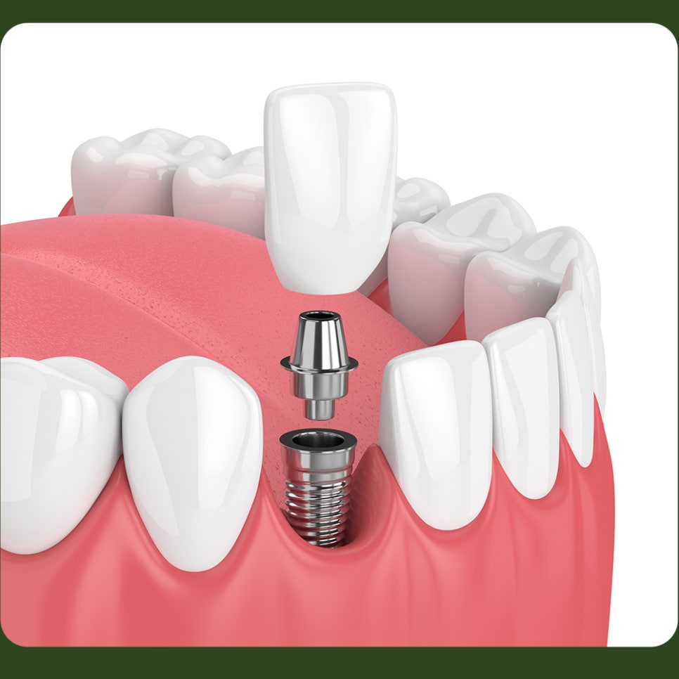 Post-Implant Care Instructions—Let’s Take a Look Together! image 3
