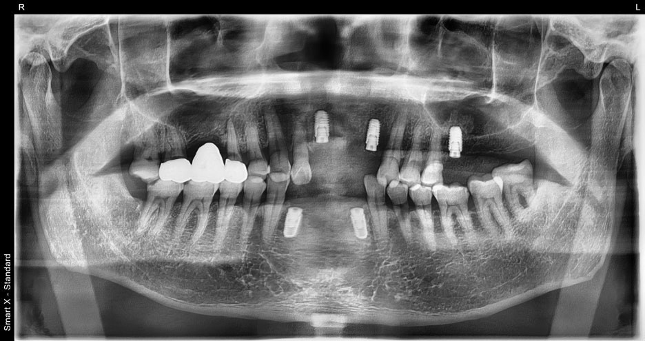 Songpa Dental Clinic: Man in His 70s Fell on Sidewalk Blocks, Requiring Laceration Suturing and Implant Surgery image 10