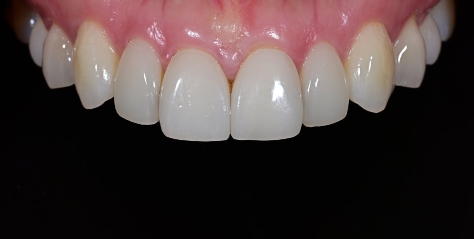 Laminate Veneers for Protruding Teeth: If They’re Too Thick, They Look Even More Prominent image 4