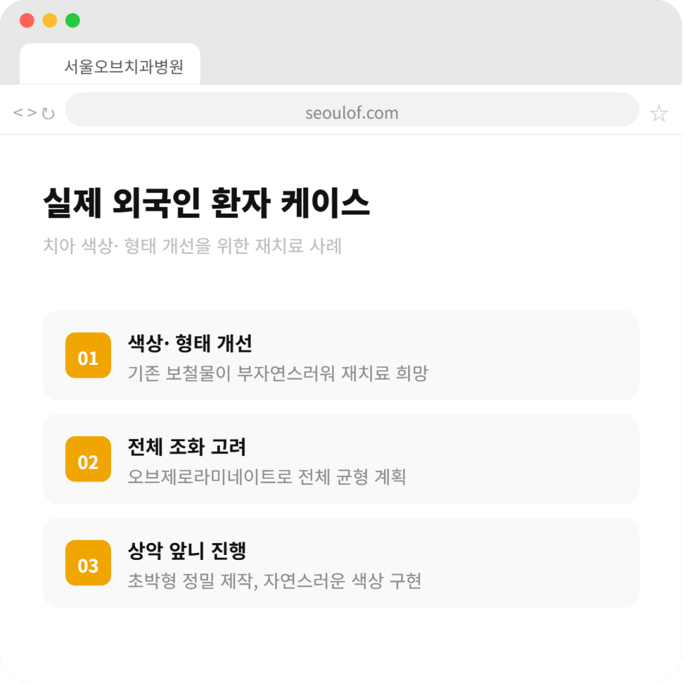 오브제로라미네이트, 무삭제라미네이트 자연스럽게 가능할까?(OVZERO Veneers, Is No-Prep Veneer Really Possible?) 관련 이미지 3