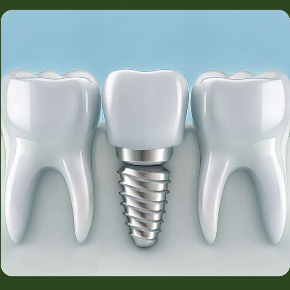 Implants for Those Aged 65 and Over: Are You Eligible? image 3