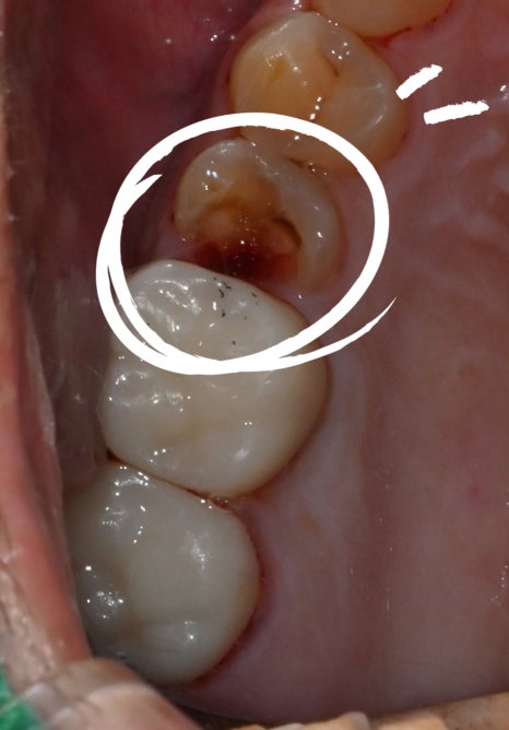 When a molar breaks, do you always need an implant? image 20