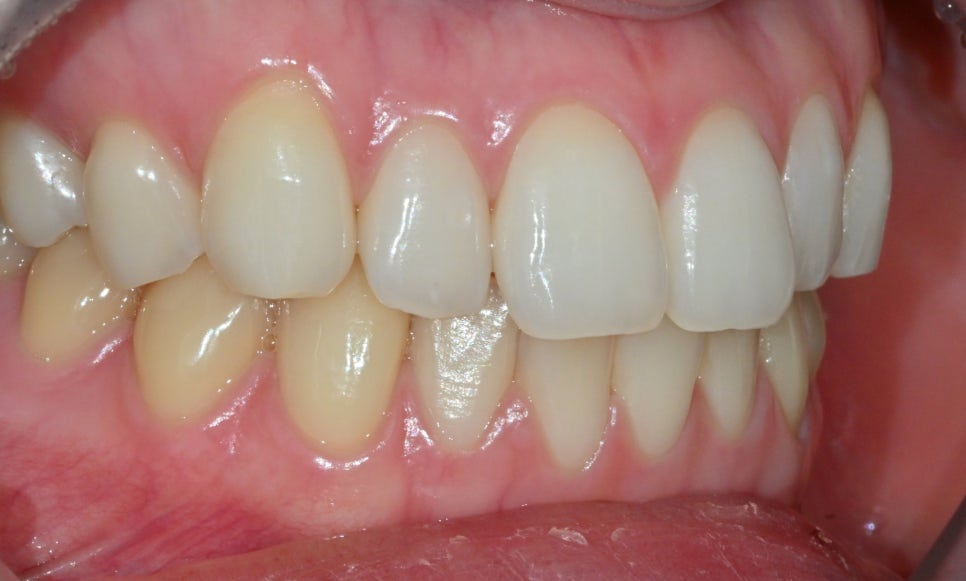 Canine Veneers Without Orthodontic Treatment image 4
