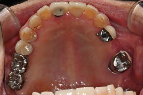 Implants Possible Even in Your 90s: Real Cases from Seoul Above Dental Clinic! image 6