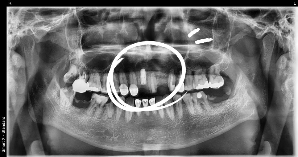 Samjeon Station Dental Clinic: A man in his 30s who visited after breaking his front tooth, and a case in which a cyst was found and implant surgery was also performed image 6