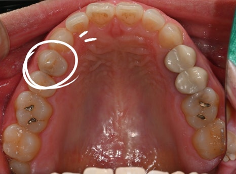 Why Cracked Molar Pain Means You May Need Root Canal Treatment image 2