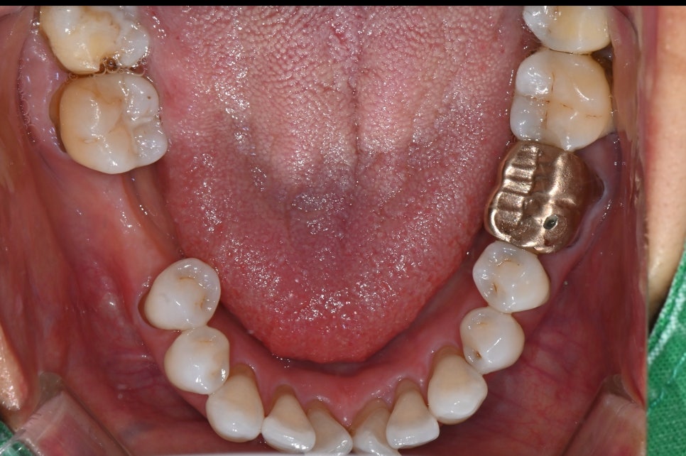 Songpa-gu Implant: Surgical Case of a Foreign Woman in Her 50s (feat. Foreigners’ Dental Clinic) image 3