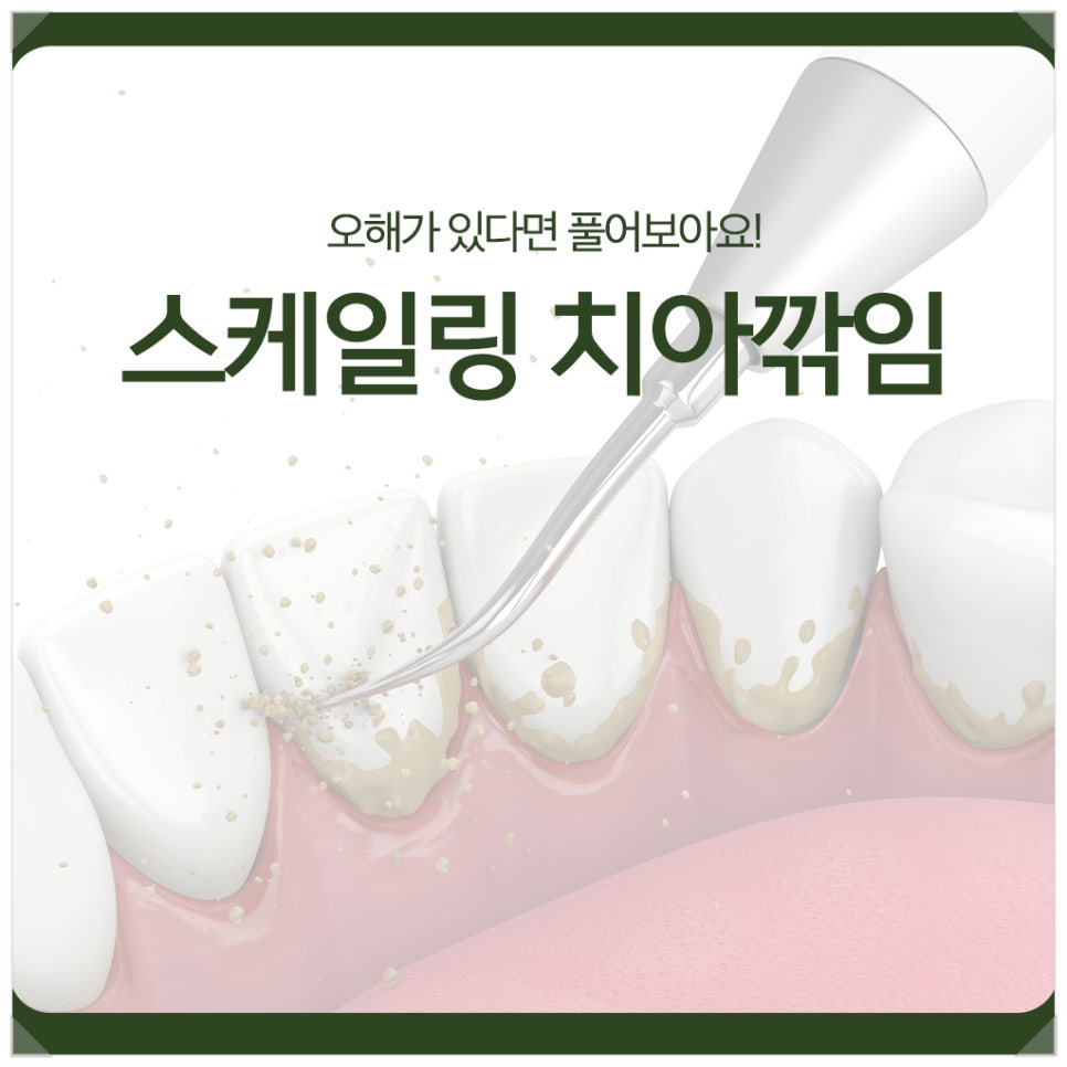 스케일링 치아깎임? 오해가 있다면 풀어보아요! 관련 이미지 1