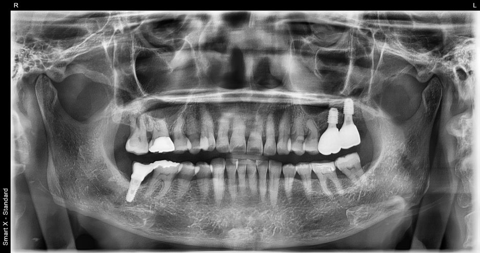 Songpa Dental Clinic: Is Insurance-Covered Implant Treatment Possible? image 16