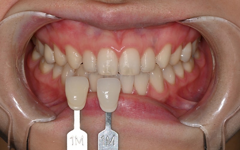 The OVZERO Laminate That Even Jamsil Dental Clinic Staff Trust and Receive! image 5